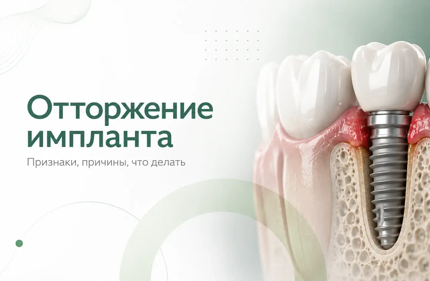 Отторжение зубного импланта